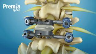 Facet Replacement Fda Study Garners Best Paper Award At Lumbar Spine Research Society Meeting